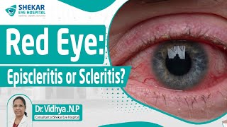 Episcleritis and Scleritis Symptoms Treatments Causes  Shekar Eye Hospital [upl. by Odraner983]