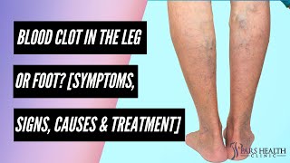 Blood Clot in the Leg or Foot Symptoms Signs Causes amp Treatment [upl. by Ardnasella]