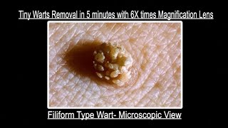 Filiform Type tiny Wart removal in 5 minutes with 6x times magnification lens Contact 9700020802 [upl. by Notniv]