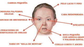 Síndrome de Down Características 📌video bien explicado Psicología [upl. by Leryt254]