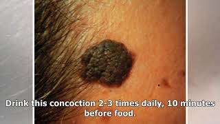 A Home Remedy for Seborrheic Keratosis That Works A Treat [upl. by Ardnatal187]