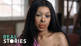 ACID ATTACK My Story Crime Documentary  Real Stories [upl. by Pavia819]