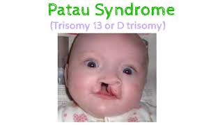 Patau SyndromeTrisomy13AnatomyGeneticsAutosomalabnormalities [upl. by Rowen]