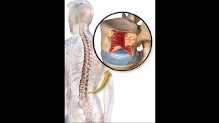 multiple bony lytic lesions [upl. by Novahc]