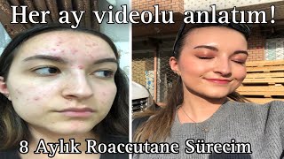 SİVİLCE TEDAVİM  Her Ay Videosunu Çektiğim 8 Aylık Roaccutane Sürecim [upl. by Chambers288]