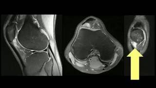 RM do joelho  Fricção tendão patelar  côndilo femoral lateral [upl. by Adnwahsor667]