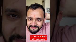 25 Months HAIR TRANSPLANT Update besthairtransplant qhthairtransplant [upl. by Gallager]