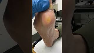 Watch a podiatrist tackle a stubborn callus Discomfort be gone 🦶🩺 PodiatryMagic [upl. by Toffey]