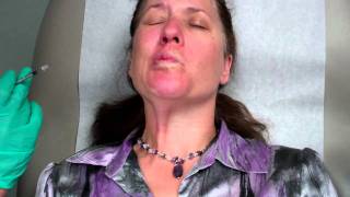 Botox Treatment for Bells Palsy [upl. by Chas]