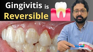 How to REVERSE Gingivitis  Best Treatment for Gum Disease  Gingivitis vs Periodontitis [upl. by Jemmie]