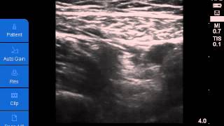 Ultrasoundguided Adductor Canal Block [upl. by Anailli]