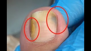 Toenail turns into black and yellow due to fungus [upl. by Muhcon]