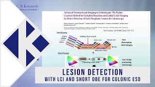 Lesion detection with LCI and Short DBE for colonic ESD with Professor Hironori Yamamoto [upl. by Mozes347]