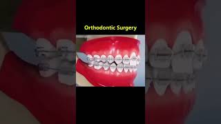 Ortho Treatment open bite العلاج التقويم للعظه المفتوحه 🎖️👌 [upl. by Janot946]