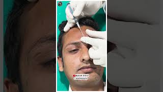 Unbelievable Skin Transformation After Subcision Treatment Awish clinic [upl. by Eenhpad]