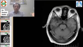 Gliosisencephalomacia by Dr Sumer Sethi [upl. by Viguerie]