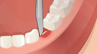 Dental Surgery Operation Root Canal Implant Anesthesia [upl. by Viviene902]