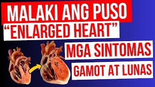 ENLARGED HEART  Lumalaki ang PUSO  Mga Sintomas Gamot at LUNAS  Cardiomegaly Heart Failure [upl. by Eiramacissej]