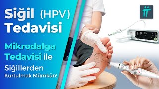 Siğil Tedavisi HPV Tedavisi Siğil Kökü Nasıl Çıkarılır I TuranampTuran [upl. by Etnahc343]