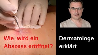 Dermatologe kommentiert Öffnen einer infizierte Zyste mit Abszess drkasten abszeß [upl. by Therine]