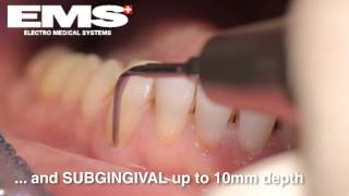 Piezon Instrument PS sub and supragingival scaling amp root debridement [upl. by Zimmerman]