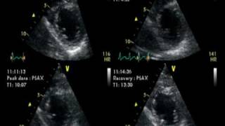 DOBUTAMINE ECHOCARDIOGRAM  ECHOCARDIOGRAPHIE DE STRESS NORMAL [upl. by Hsot620]