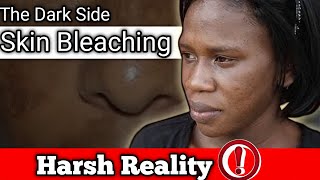 Skin Bleaching Harmful Truths You Need to Know [upl. by Link]