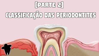 Aula de Classificação das Doenças Periodontais  Concursos Para Dentistas Dentista Estuda 6 PT 2 [upl. by Gothard]