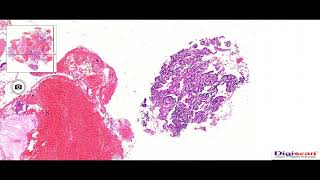 FGT Rare Case of Endometrial Carcinoma Associated with Pregnancy  by Dr Mithilesh Chandra [upl. by Edivad]