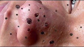 Acne treatment Blackhead remove with Spa Loan [upl. by Ungley104]