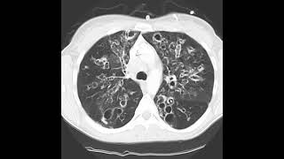 Bronquiectasias varicosas em fibrose cística [upl. by Candra581]