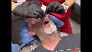 CRNA Anesthesia Nasal Intubation POV Dental Office [upl. by Flatto]