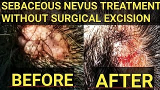 One Solution for all skin problems Dr Parash Shrestha  Sebaceous Nevus Treatment [upl. by Ettegroeg206]