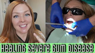 My Experience With SEVERE Gum Disease Periodontal disease diagnoses treatments amp natural healing [upl. by Nnaeel]