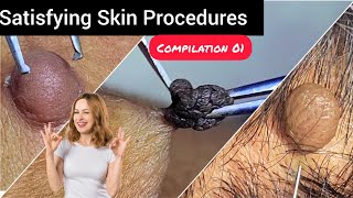 Care to skin and Relax to mind Satisfying skin tag removal compilation 01 DrAMAZINGSKIN [upl. by Ayoral]