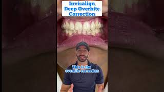 How we corrected a deep overbite for a patient using Invisalign clear aligners [upl. by Finzer]