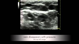 discrimination between vein and artery [upl. by Lampert]