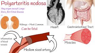 Polyarteritis nodosa  symptoms and treatment [upl. by Rumpf]