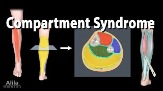 Compartment Syndrome Animation [upl. by Bryner]