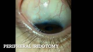 Peripheral Iridotomy [upl. by Clim599]