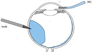 21 Surgical management of choroidal detachment for dummies [upl. by Rahsab214]