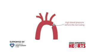 Coarctation of the Aorta [upl. by Mitchiner108]