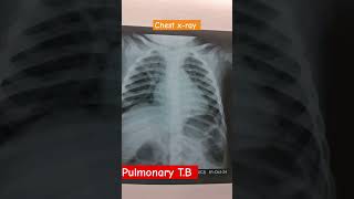 pulmonary TB chest xray radiology medical doctorslife [upl. by Anirual280]