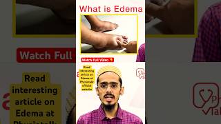 Edema क्या होता है  इसके Types क्या होते है  edema swelling shortsfeed [upl. by Los679]