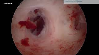 SUBSEPTATE UTERUS ON HYSTEROSCOPY [upl. by Airitak]