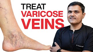 VASCULAR SURGEON Shares 11 Proven Ways to TREAT VARICOSE VEINS [upl. by Nnaaihtnyc921]