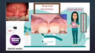 frenectomy ادوات جراحة dentalassistant سلسلهمساعدطبيبالاسنان [upl. by Alien]