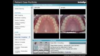 Invisalign Deep Bite [upl. by Aracahs]