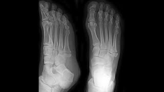 5th Metatarsal Base Fracture Foot [upl. by Adihsar]