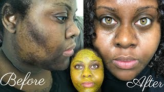 5 DAY TURMERIC FACE MASK CLEARED MY HYPERPIGMENTATION IM SHOOK [upl. by Irolam231]